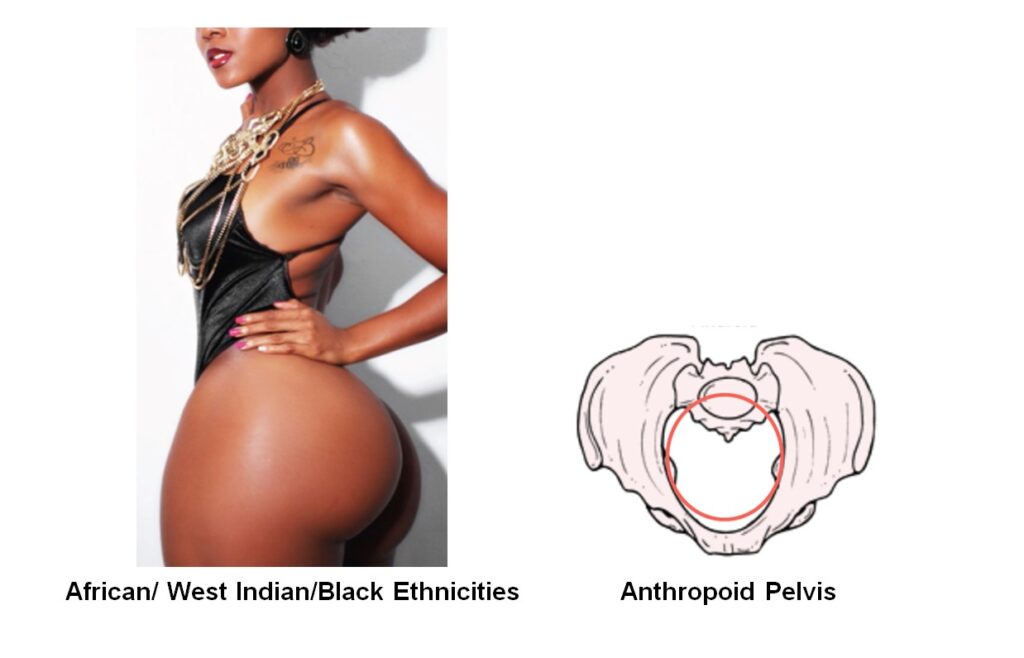 Ethnic Pelvic Shapes